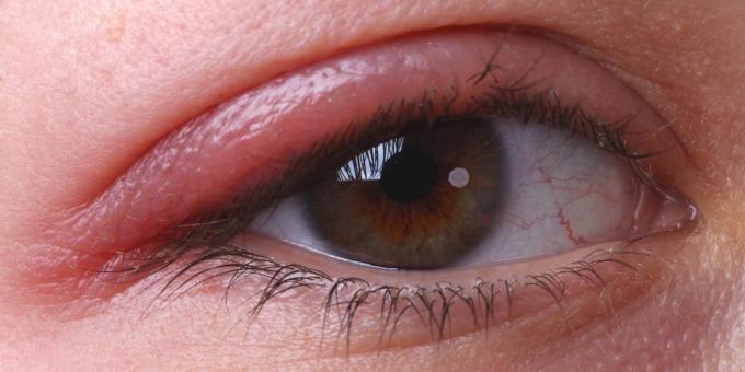 Kodėl niežti akys: blefaritas