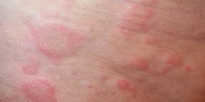 Alergijos vaikui: Viskas tėvai turi žinoti apie diagnostiką ir gydymą