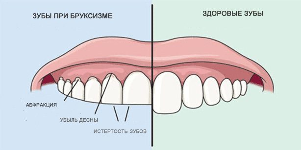 Dantų šlifavimo: sveiki dantys ir dantų bruksizmas metu