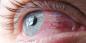 Konjunktyvitas: kodėl parausta akys ir kaip juos gydyti