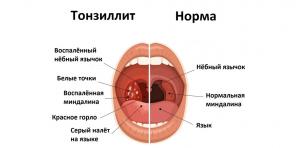 Lėtinis tonzilitas: simptomai, komplikacijos, gydymas ir dar daugiau