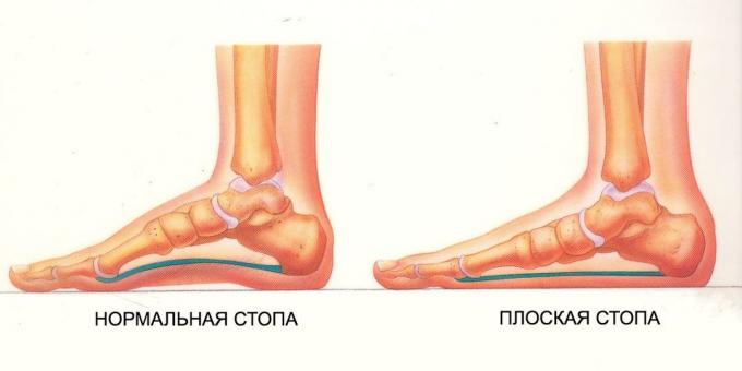 pratimai plokščių pėdų: įprasta ir plokščio pėsčiomis