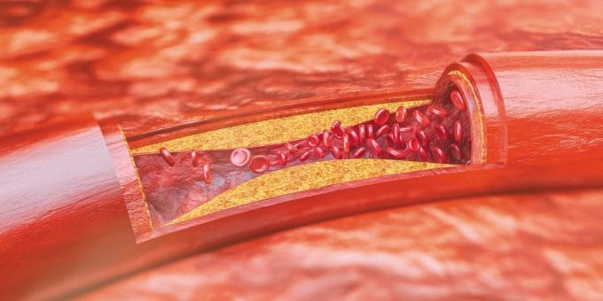 Cholesterolis: aterosklerozinių plokštelių