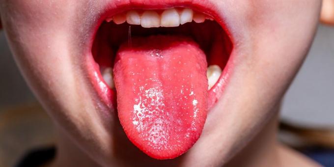 Skarlatinos simptomai: braškių liežuvis