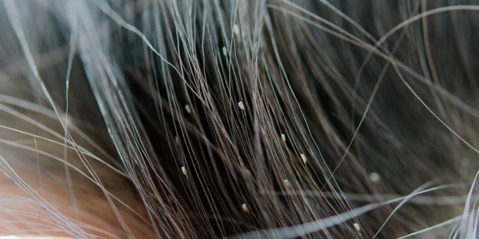 Galvinių utėlių simptomai: spuogai ant plaukų